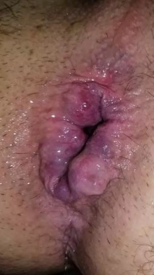 I got destroyed this weekend. This is two days after the event.