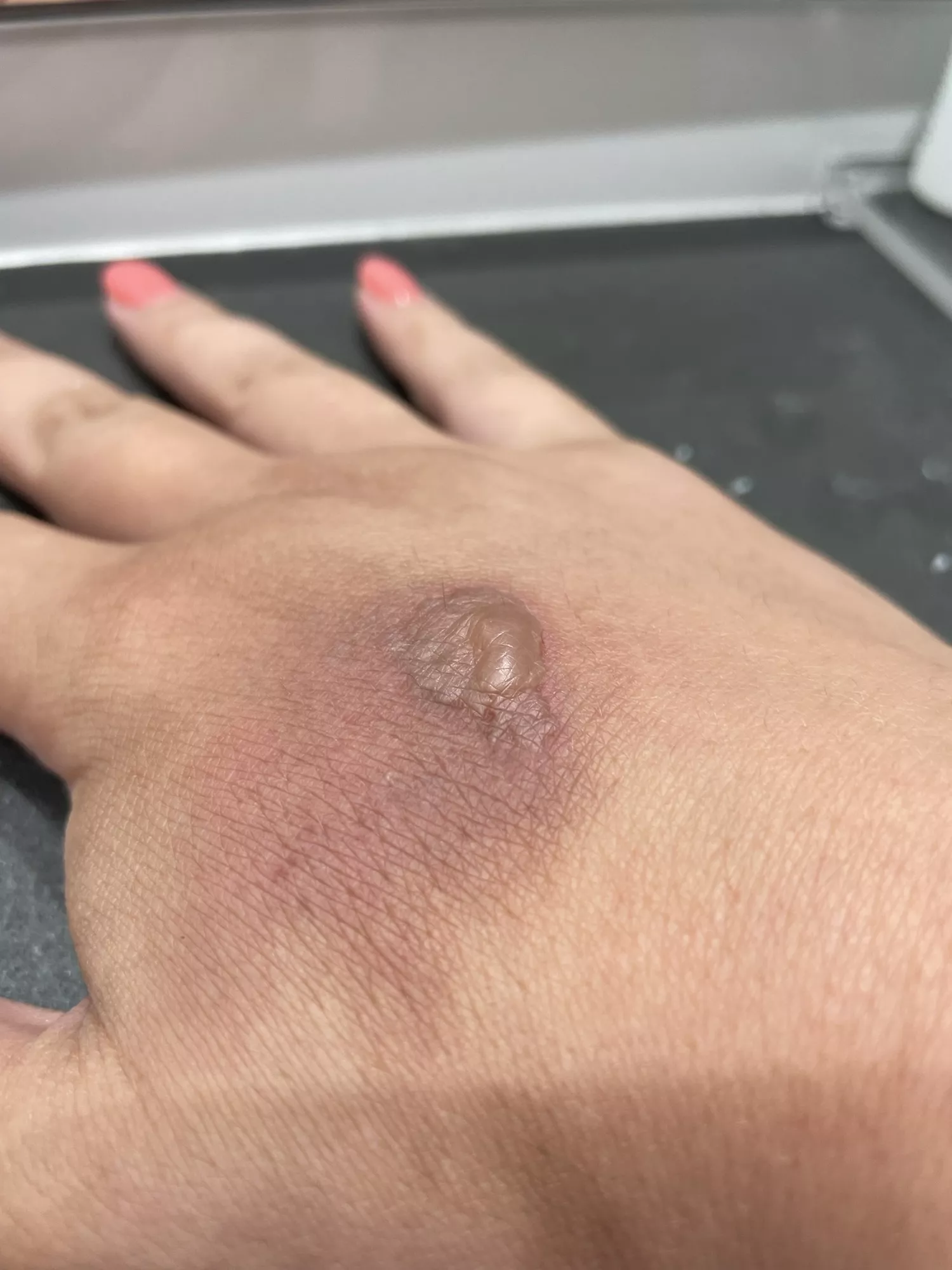 I know I really shouldn’t…[spider bite]