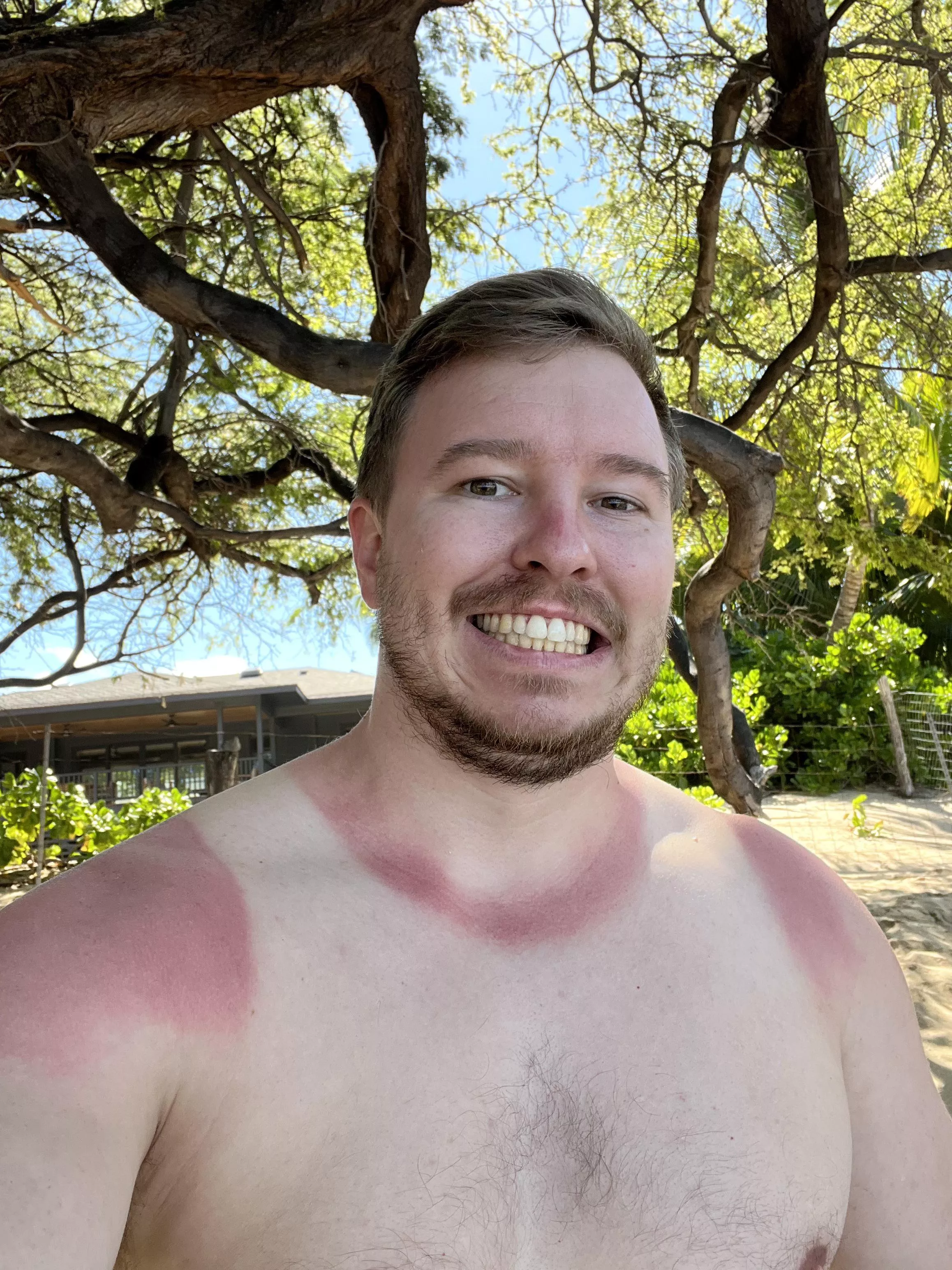 I may have gotten burned a little