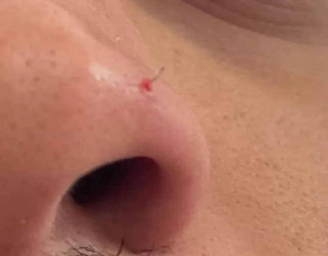 I popped a pimple on my nose and it turned out to be an ingrown hair.