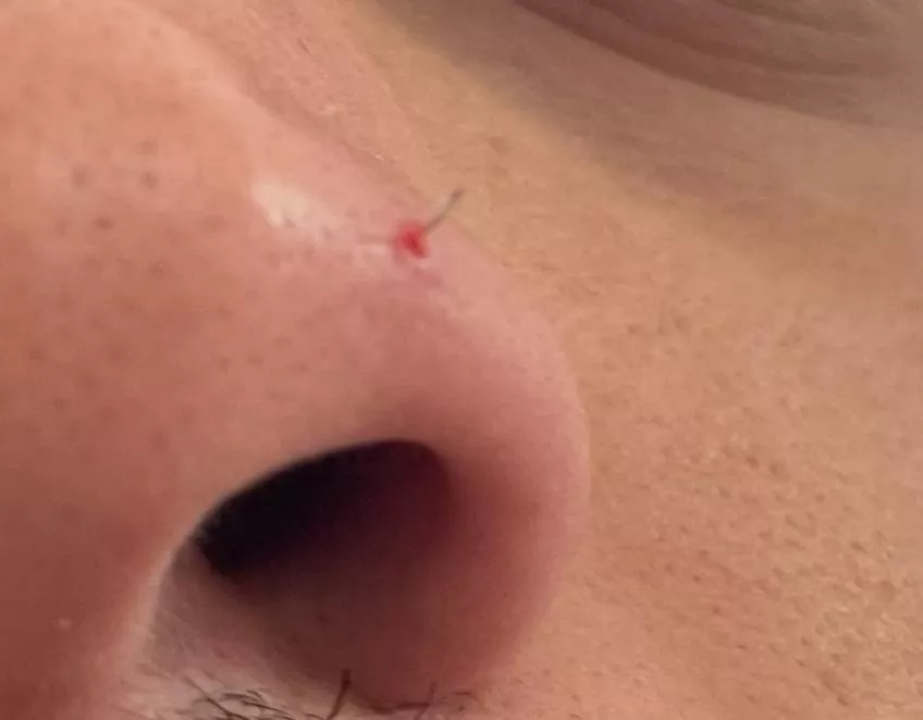 I popped a pimple on my nose and it turned out to be an ingrown hair.