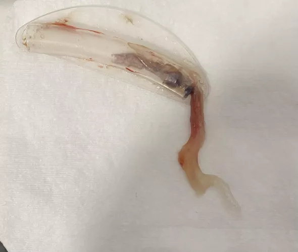 I recently had a septoplasty, it felt like I was pulling part of my brain out.