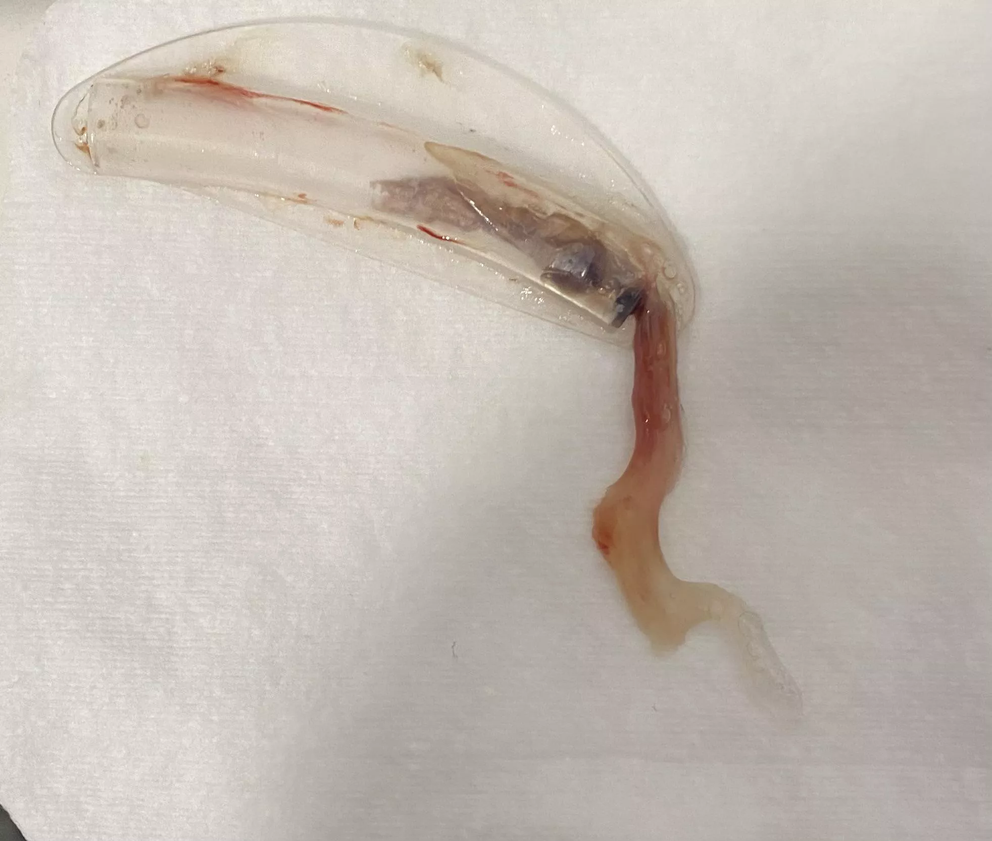 I recently had a septoplasty, it felt like I was pulling part of my brain out.