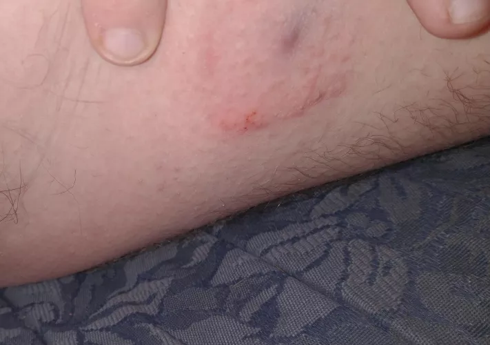 I used a hydrocoiod bandaid on a pimple, and drianed a lot out, pretty sure the purple is just scar tissue / bruising. but now I'm having a bad blister reaction to the adhesive!