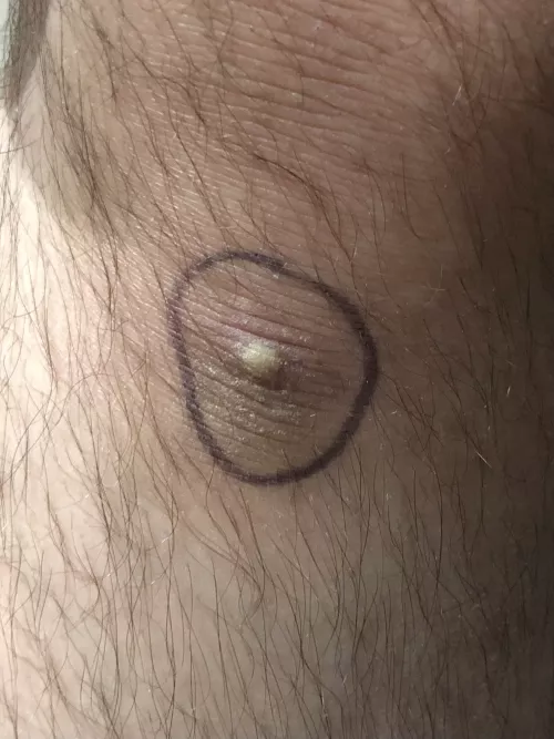 I want to pop it so badly