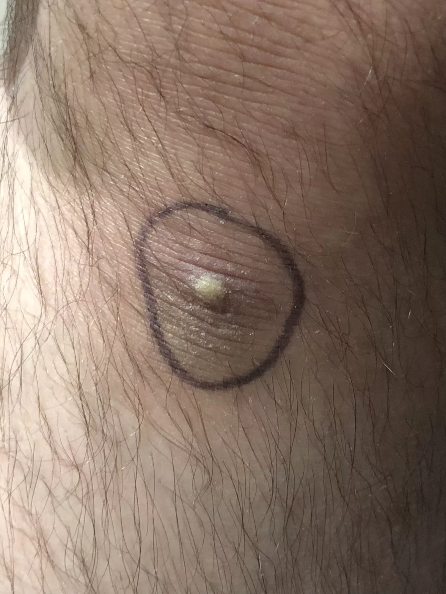 I want to pop it so badly