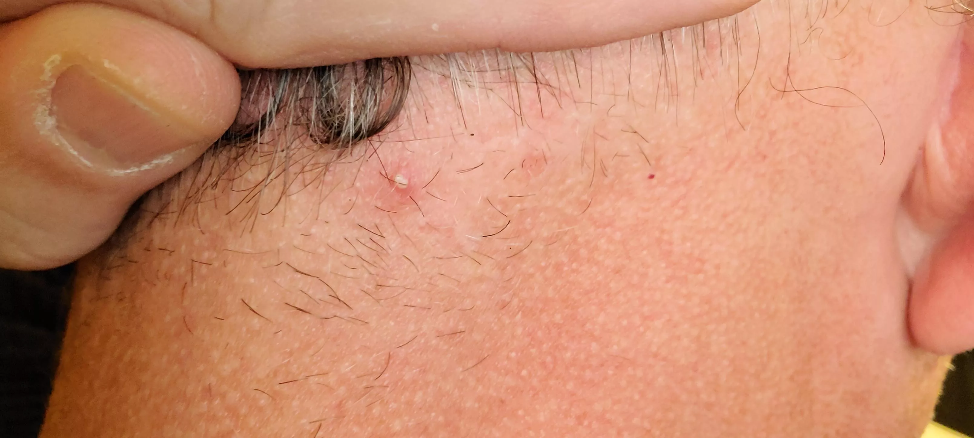 It's on the back of my neck, don't know how to capture