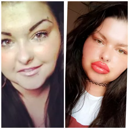 I've evolved !!! New lips yesterday another 1cc in π I want more now ! I'm so greedy