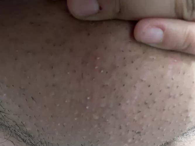 “let’s try an expensive shower razor over the electric razor” shave burn. Never again! And I missed a ton! Warm compress helped tho.