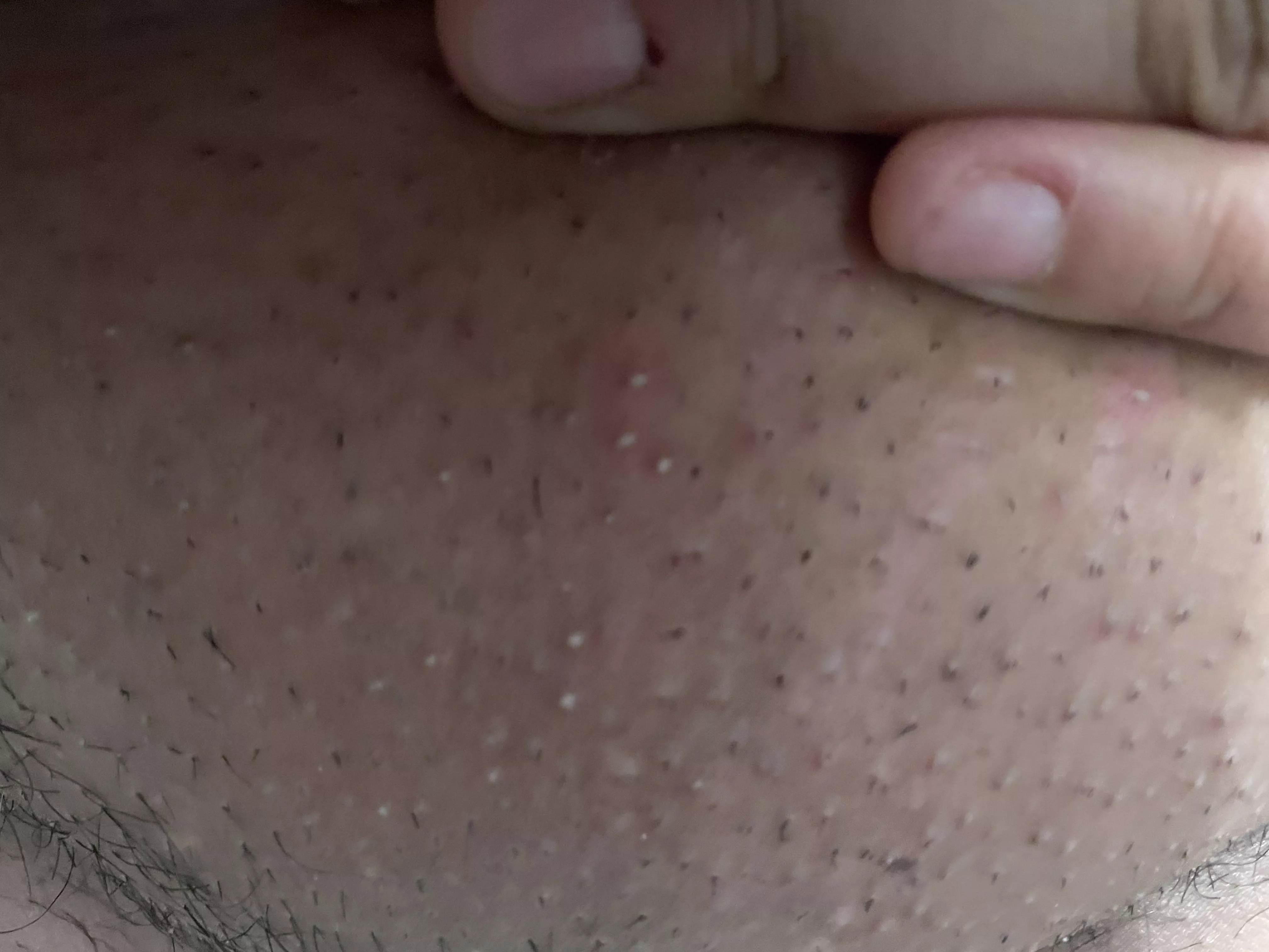 “let’s try an expensive shower razor over the electric razor” shave burn. Never again! And I missed a ton! Warm compress helped tho.