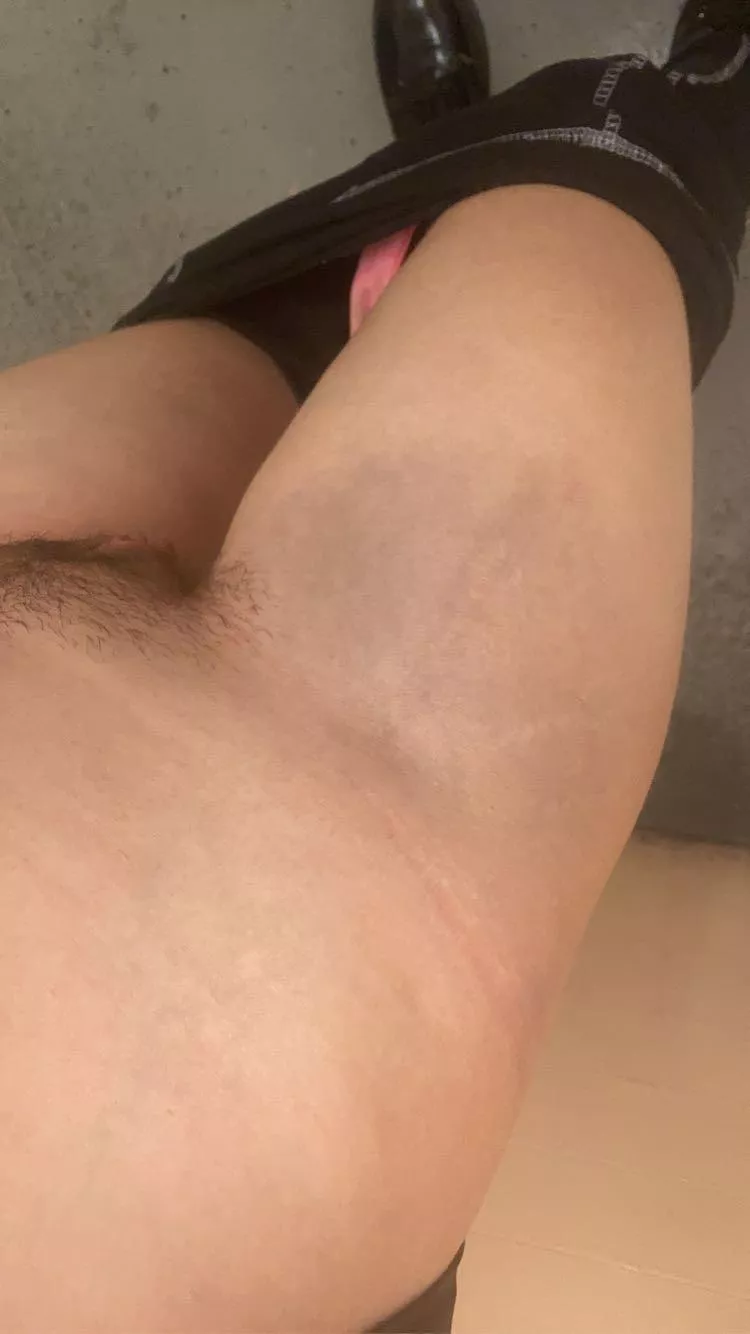 look at my bruised thigh🥲