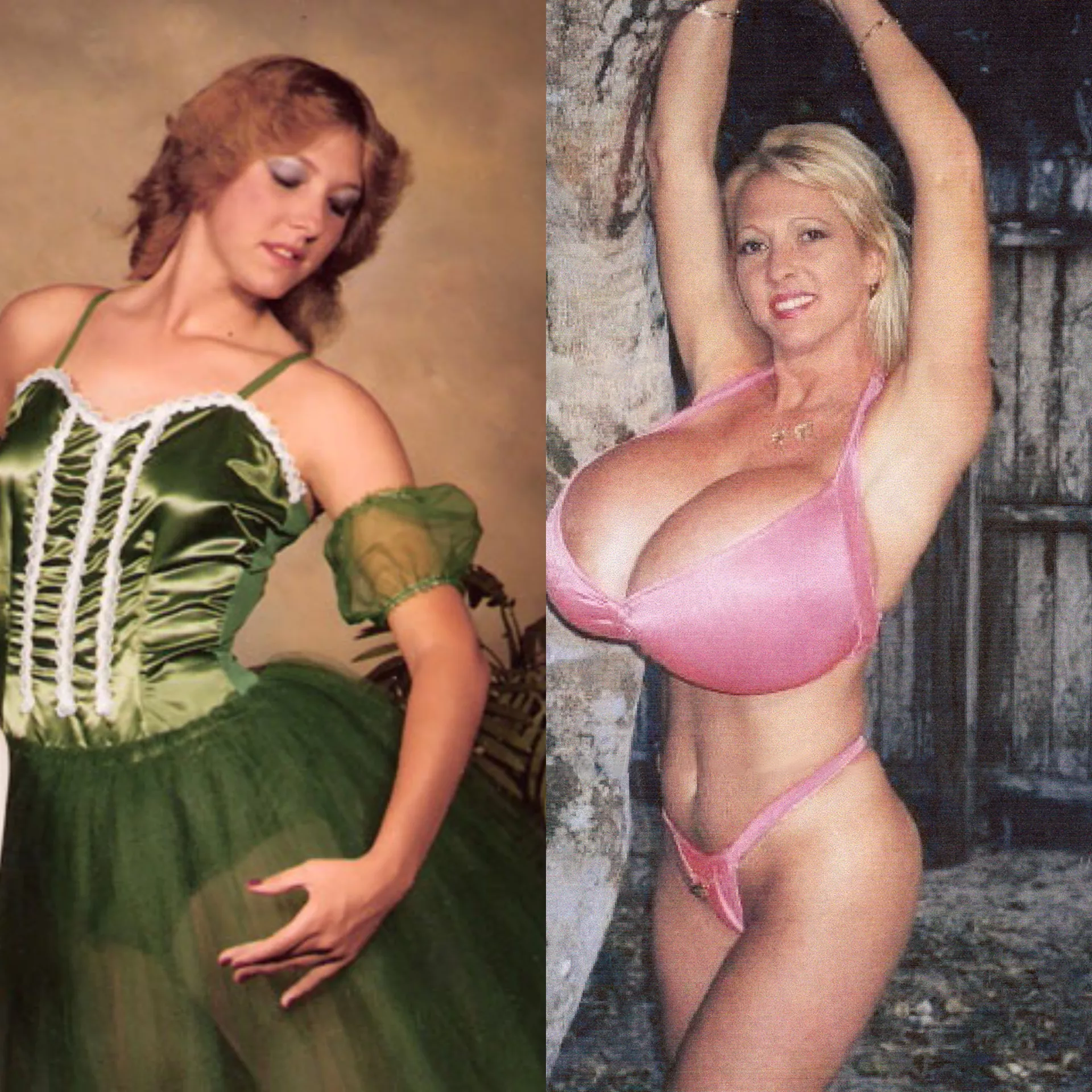 Maxi Mounds before and after. Guinness world record for biggest implants Maxi Mounds before and after. Guinness world record for biggest implants
