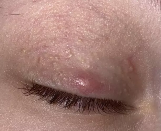 Milia Infected? I stupidly tried popping it. What to do? It's been 3 days of being swollen. I've tried teabags, warm compresses. I've had them for years.