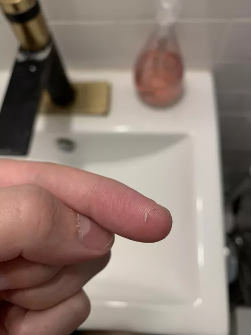 My default is cystic acne, so it’s nice to get some hairy pops once in a while!