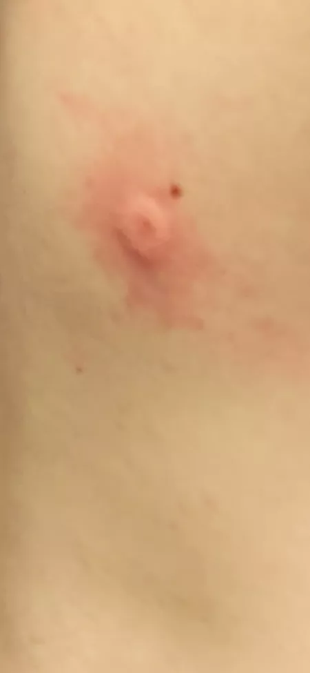 My friend shot my friend with a BB gun and grew an inverted nipple out of his back