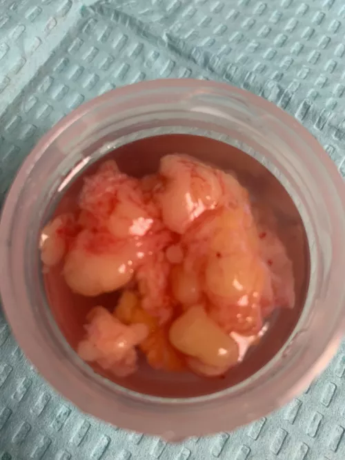 My friend’s lipoma from her back