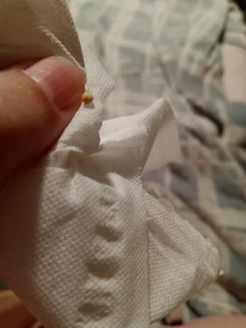 My husband got this milia/skin pearl off of me and told me to share it because it was so big 😭