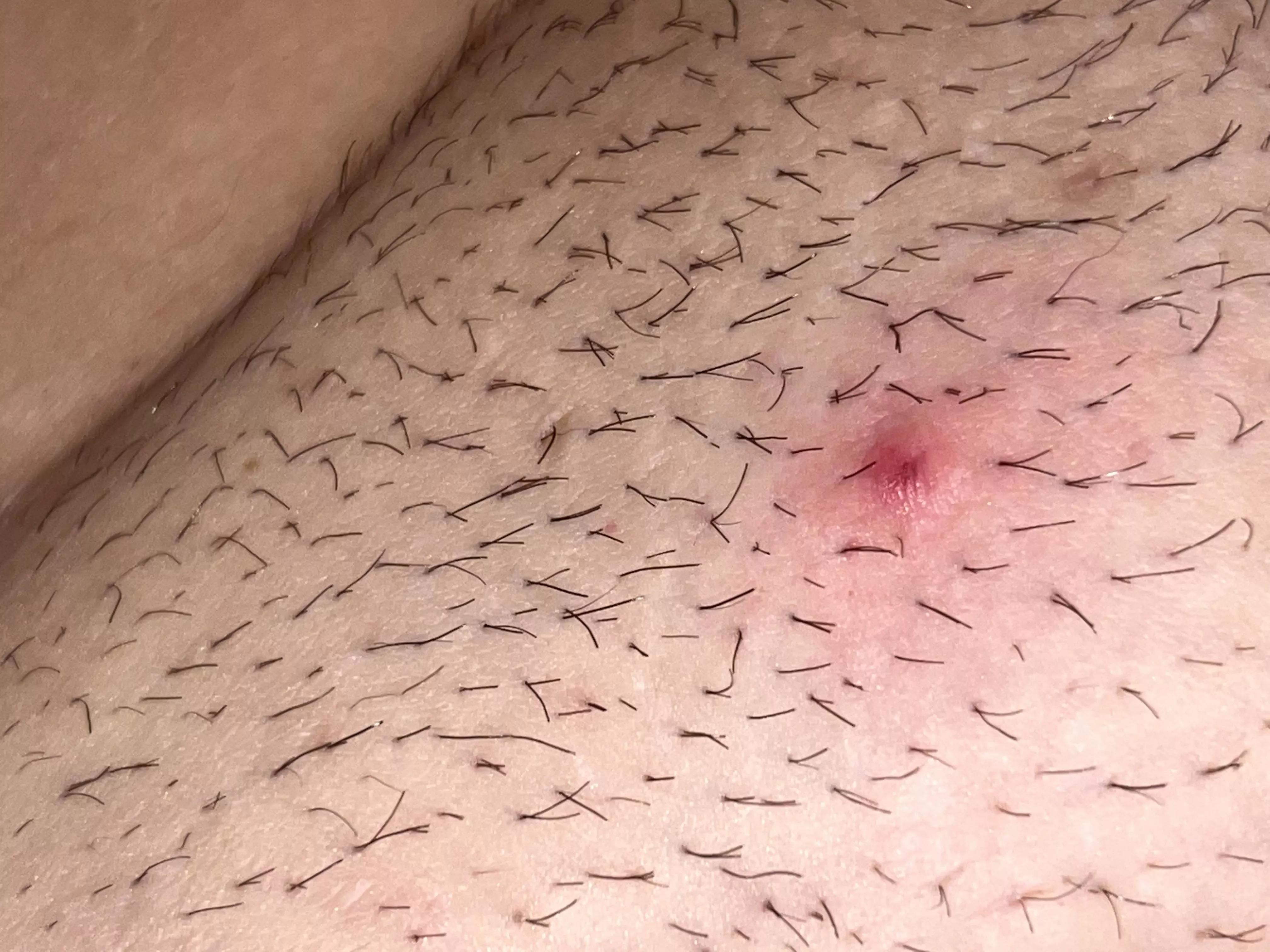 My pubes suck! So many double or triple hairs causing ingrowns! NSFW because beaver.