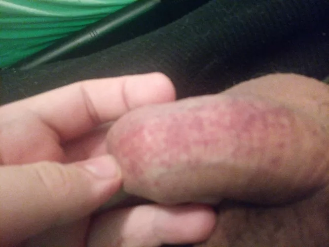 New to pumping and need help (petechiae appears after every time a try cock pumping )