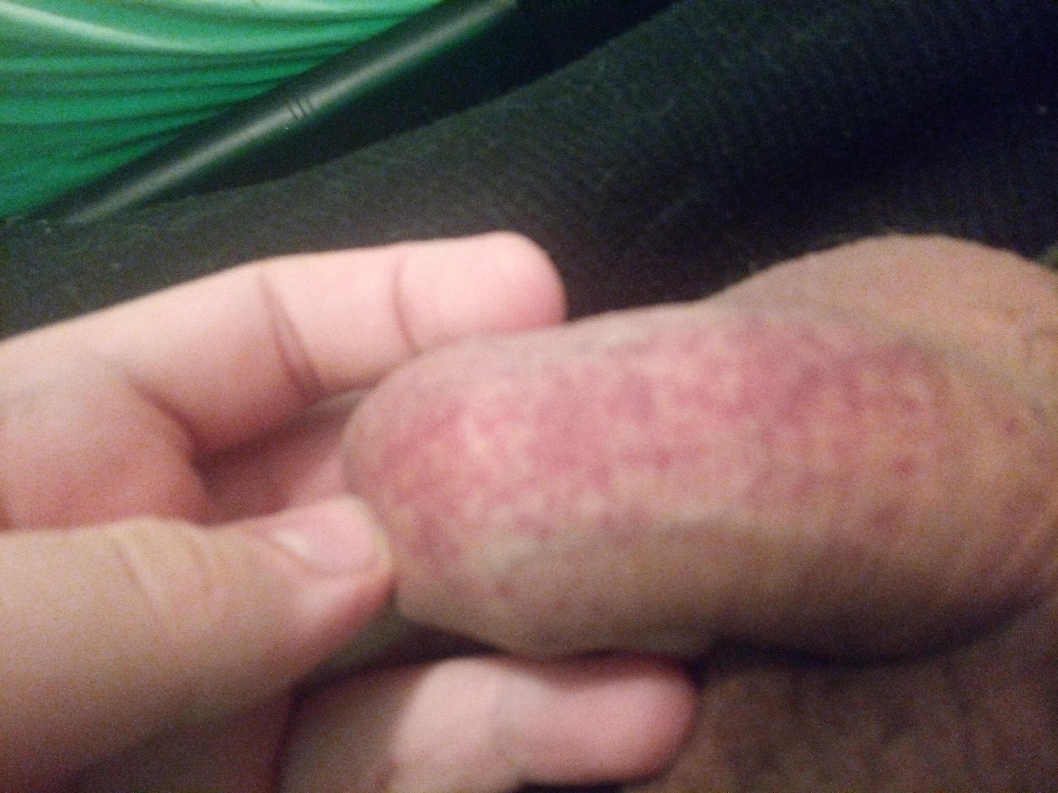 New to pumping and need help (petechiae appears after every time a try cock pumping )