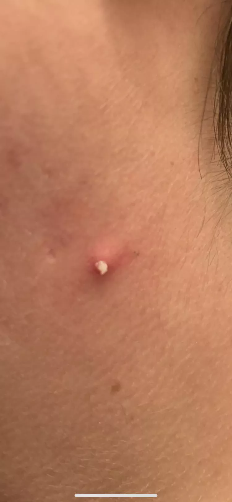 Nice pop on my neck this morning