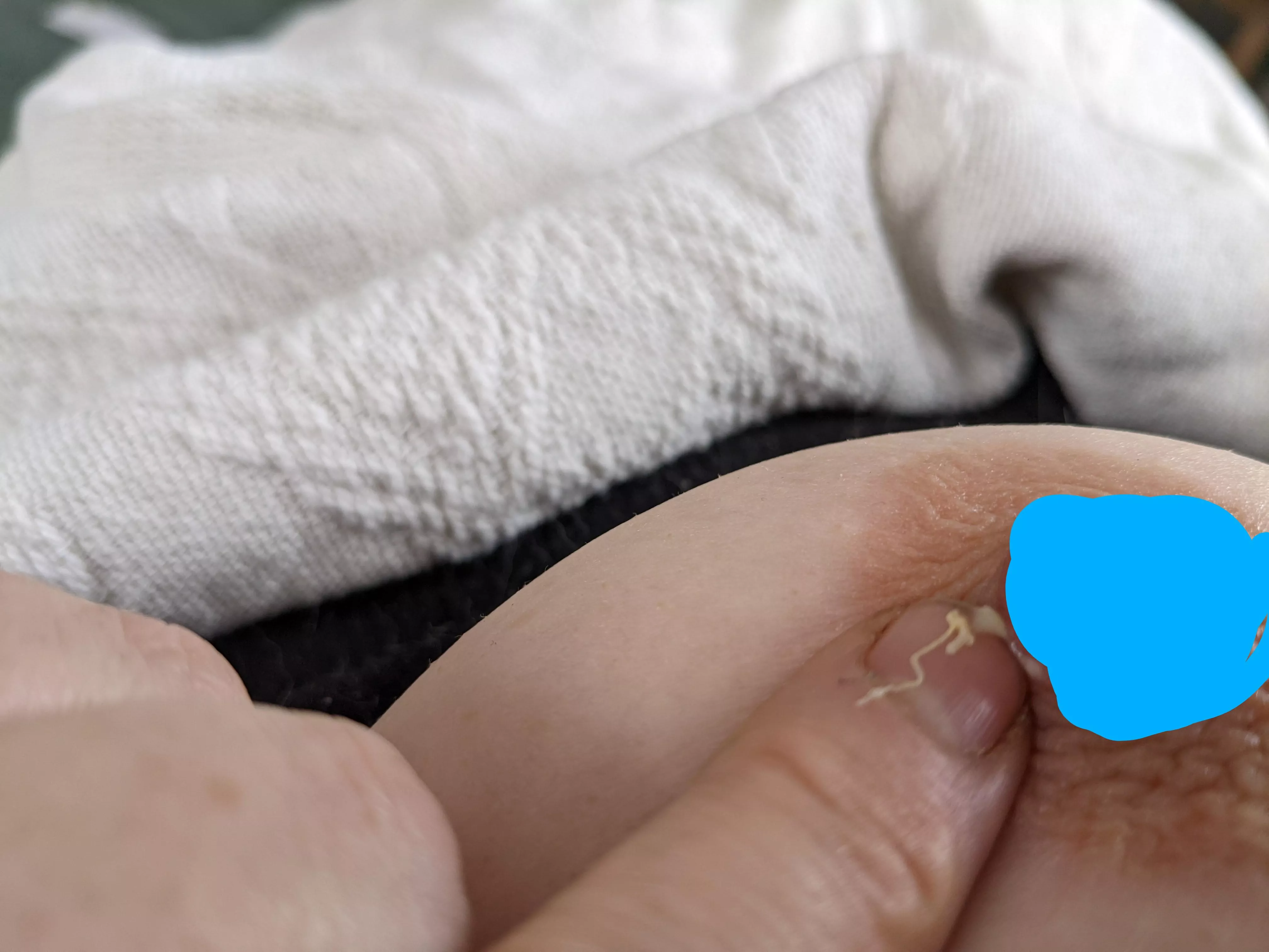 NSFW old nipple piercing (removed in 2009)