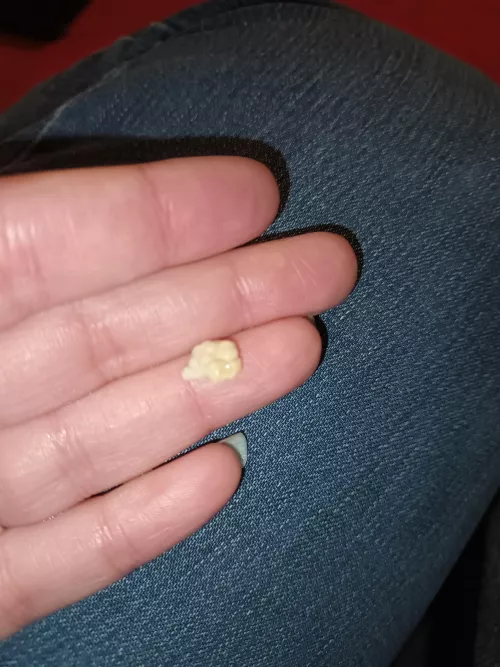 NSFW sorry no pop but just had this huge tonsil stone come out has anyone else had a big one took me by surprise.