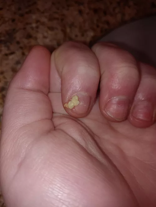 [oc] hadn't looked at my tonsils for a week or so and got these gems all at once (also just got acrylic nails off so don't mind my nails)
