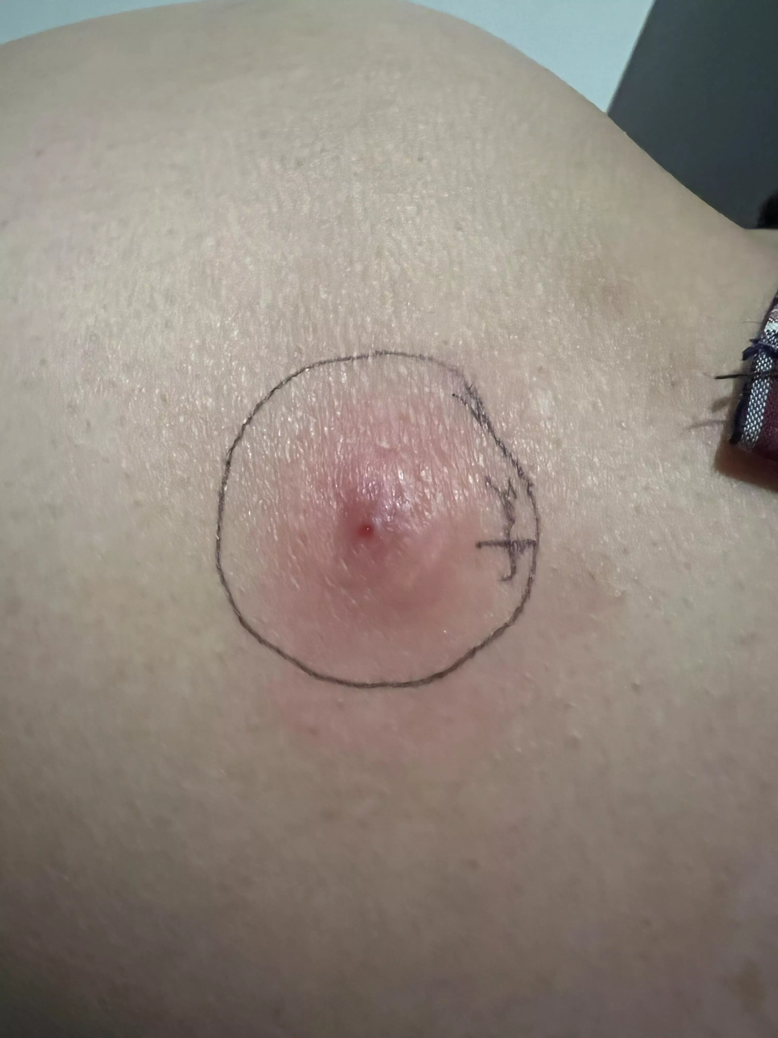 On my husbands hip, waiting to see how it goes