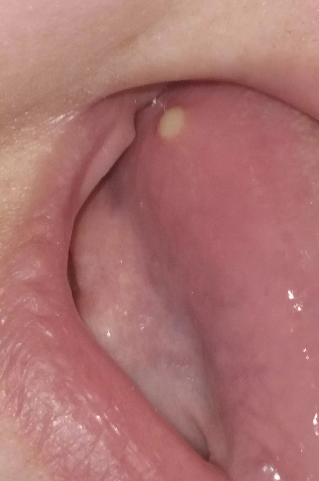 On the tongue, finally popped on its own but ewwww