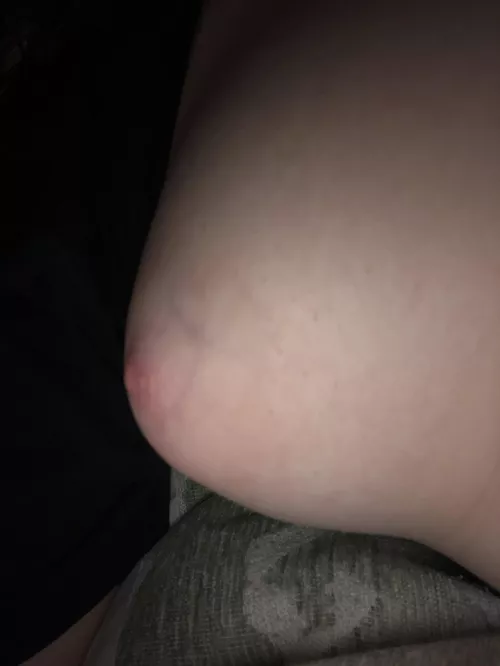Pale areolas