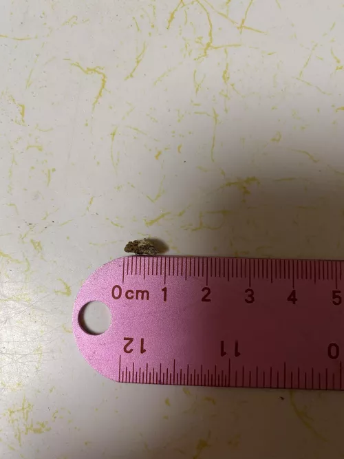 Passed a kidney stone.