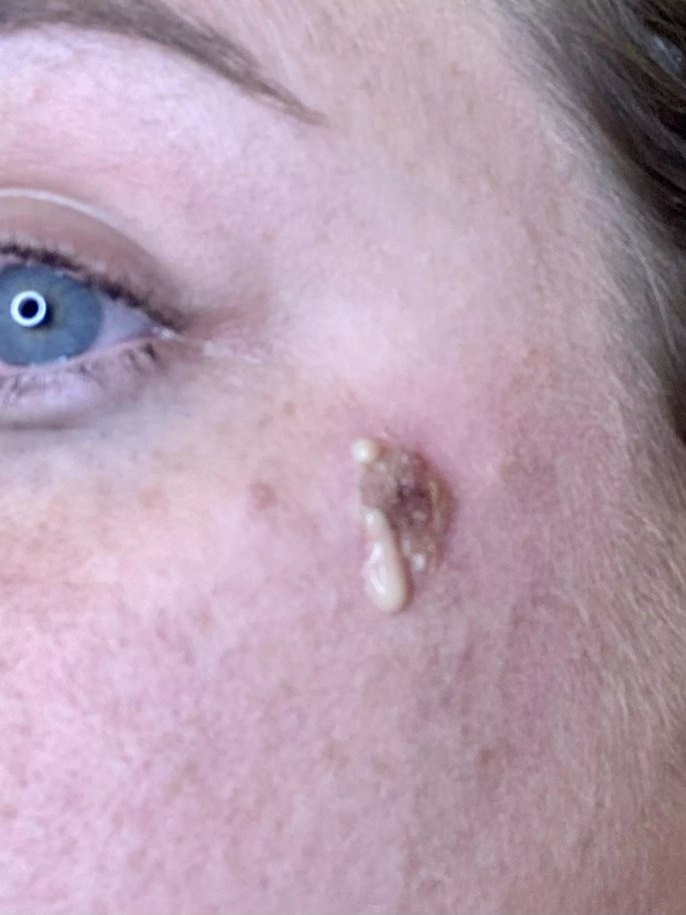 Popped my infected pimple turned abscess. Sooo satisfying and equally disgusting.