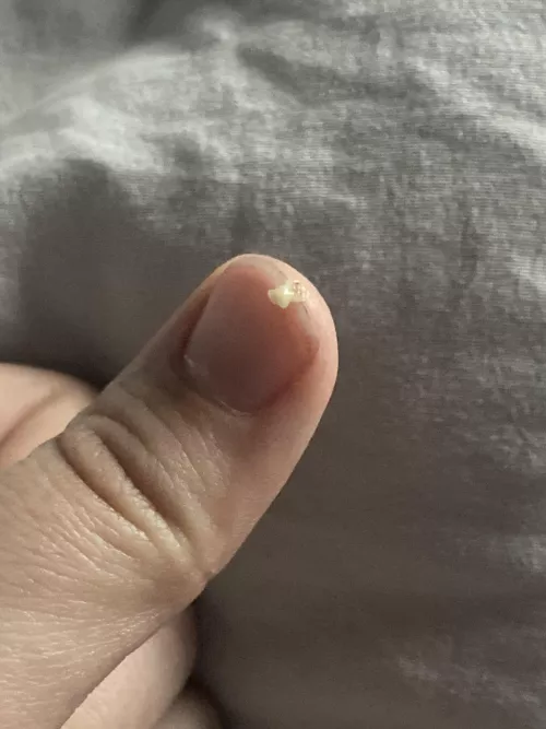Pulled this new friend out of my nose a few minutes ago (A cyst according to my sister, though we may be wrong)