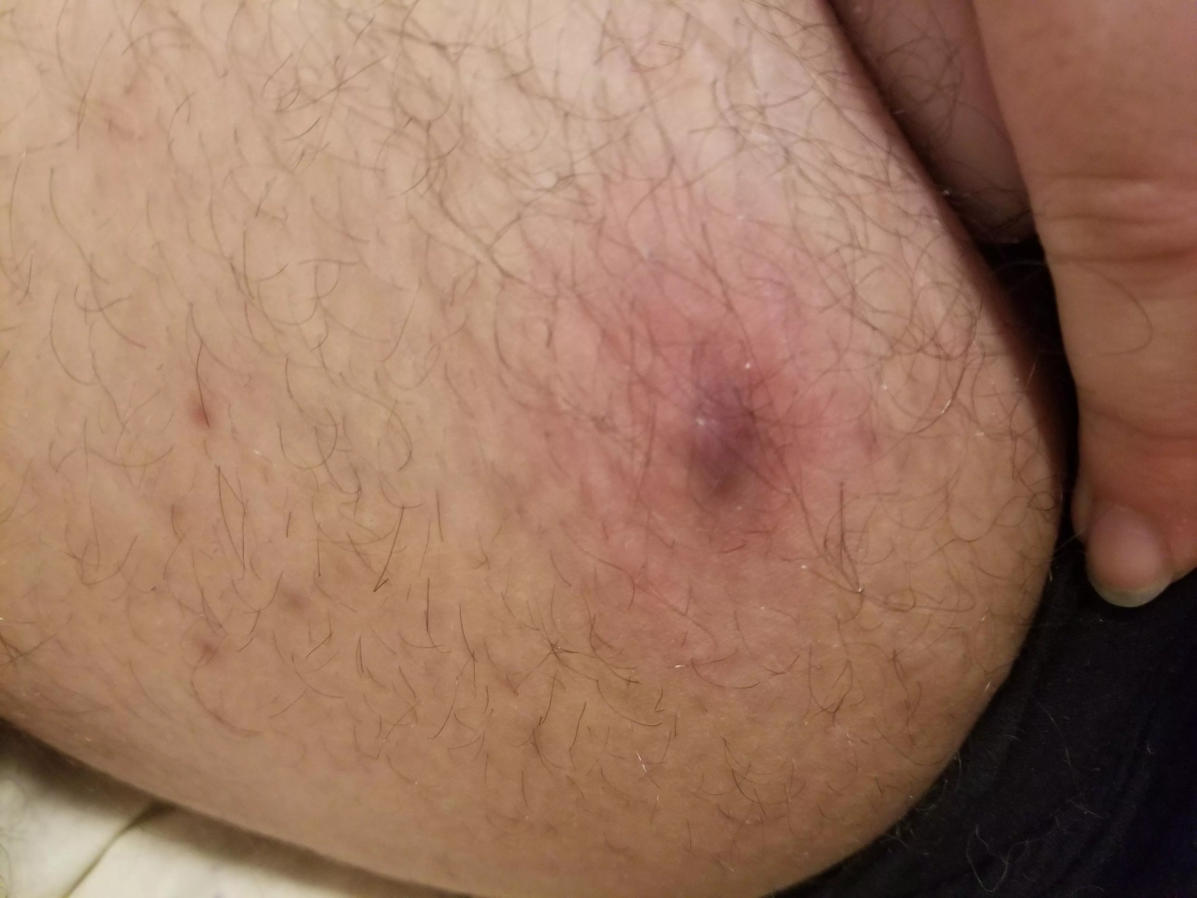 Really want to pop it but probs shouldn't. Doesn't hurt much at least