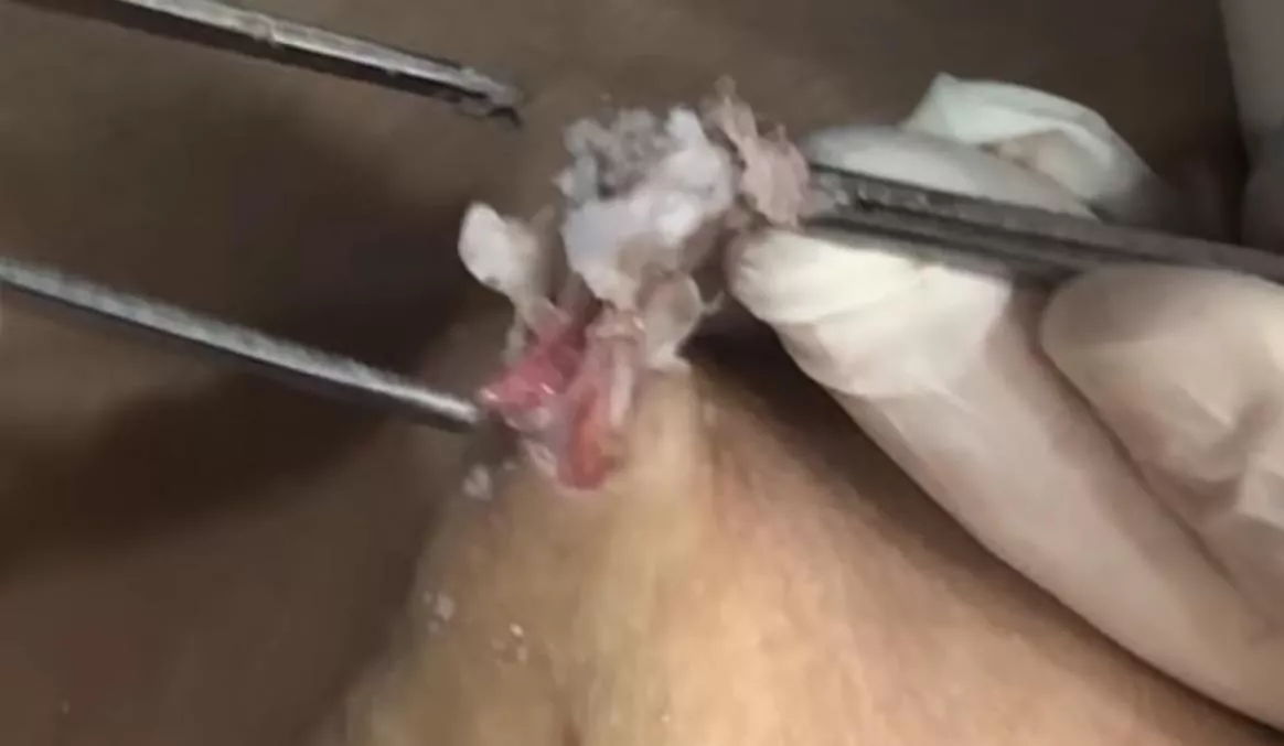 Savage attempted removal of epidermal cysts WARNING It’s unbelievably frustrating & had very scary use of rat tooth tweezers! Link in comments.