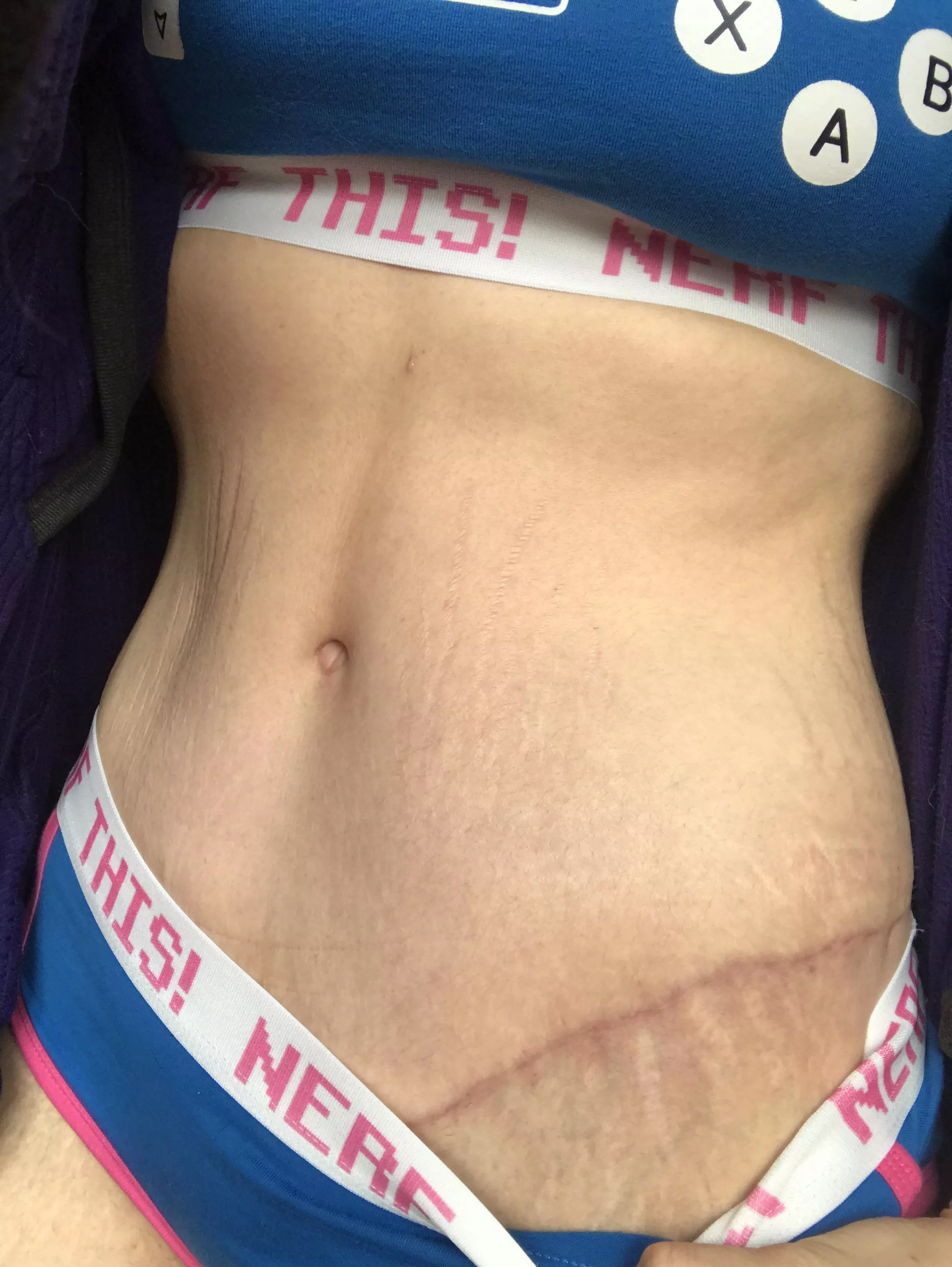 Scars or stretch mark fetish?