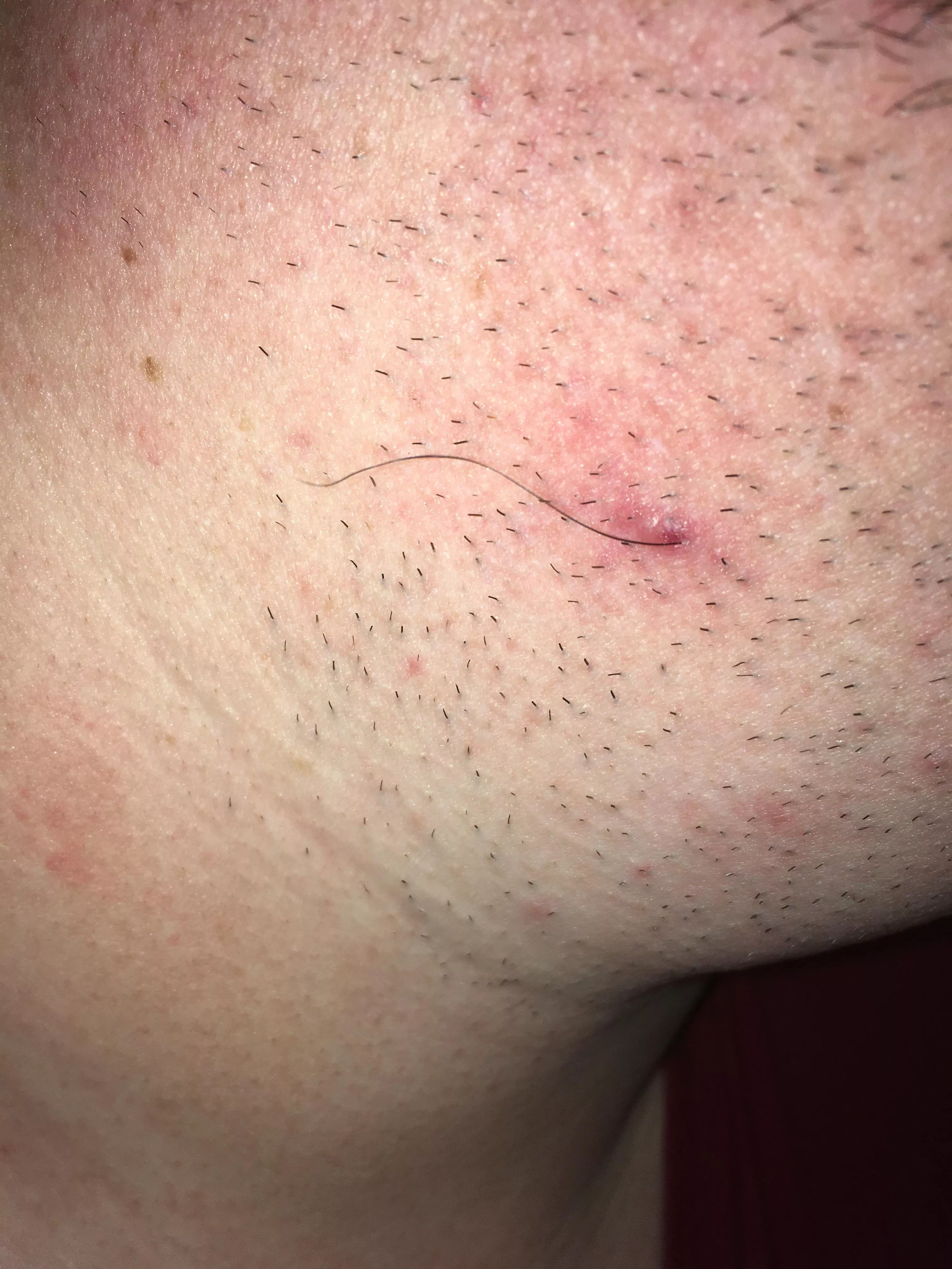 Scratched what I thought was some dead skin from an old bump on my neck. This hair came with it.