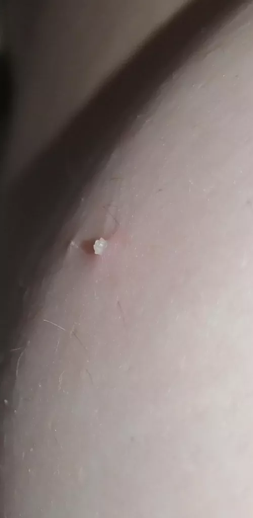 Small gem I found on the side of my boob