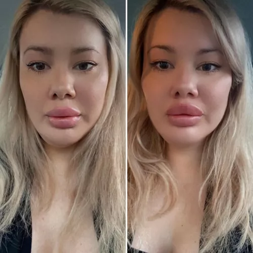 So excited by my new lips, cheek filler and Botox. I dribble without a straw and canβt wait for my frozen face to set in in the next day or so. ππ