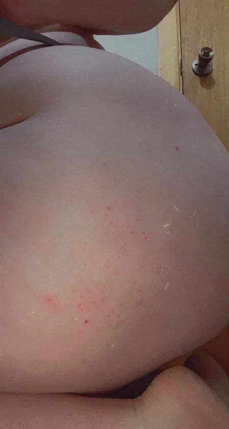 Sorry bout the eczema but that’s life, my ass is phat