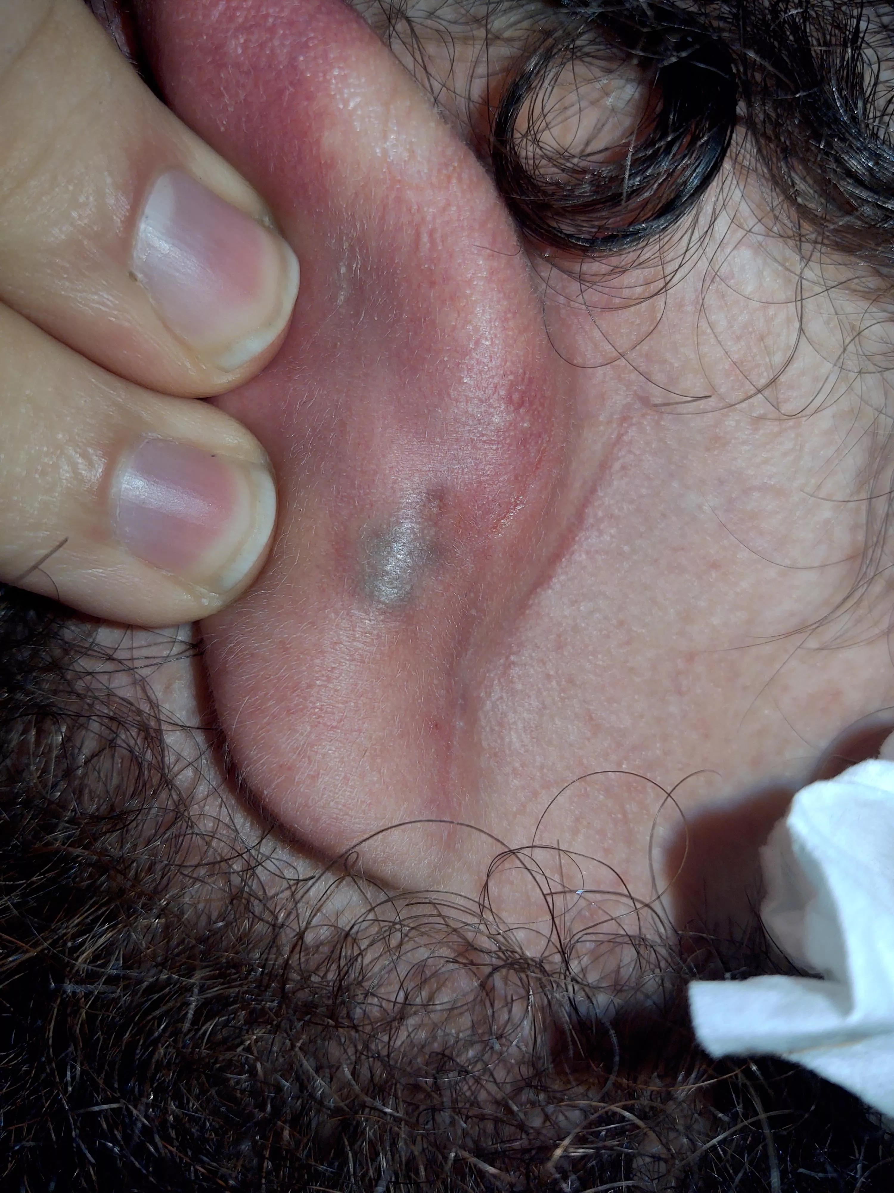 Spouse has a weird blood blister behind ear. Not sure if we should leave it alone or attempt to pop it? He has had it for a few weeks