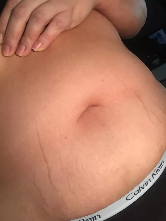 Stretch marks starting to show ππ³ Stretch marks starting to show ππ³