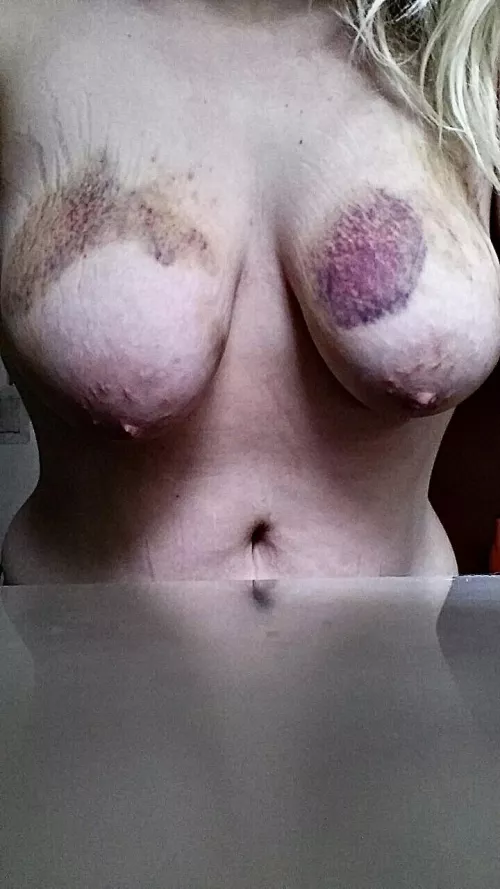 Stretchs marks fetish