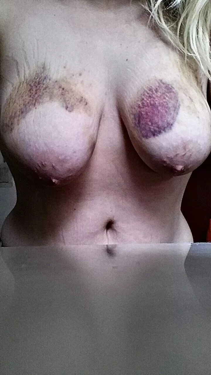 Stretchs marks fetish