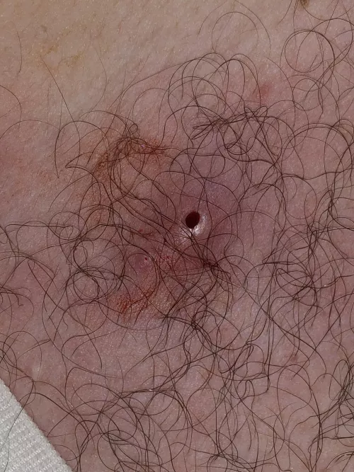 The remnants of a jumping spider bite I got on my chest. Was very leaky