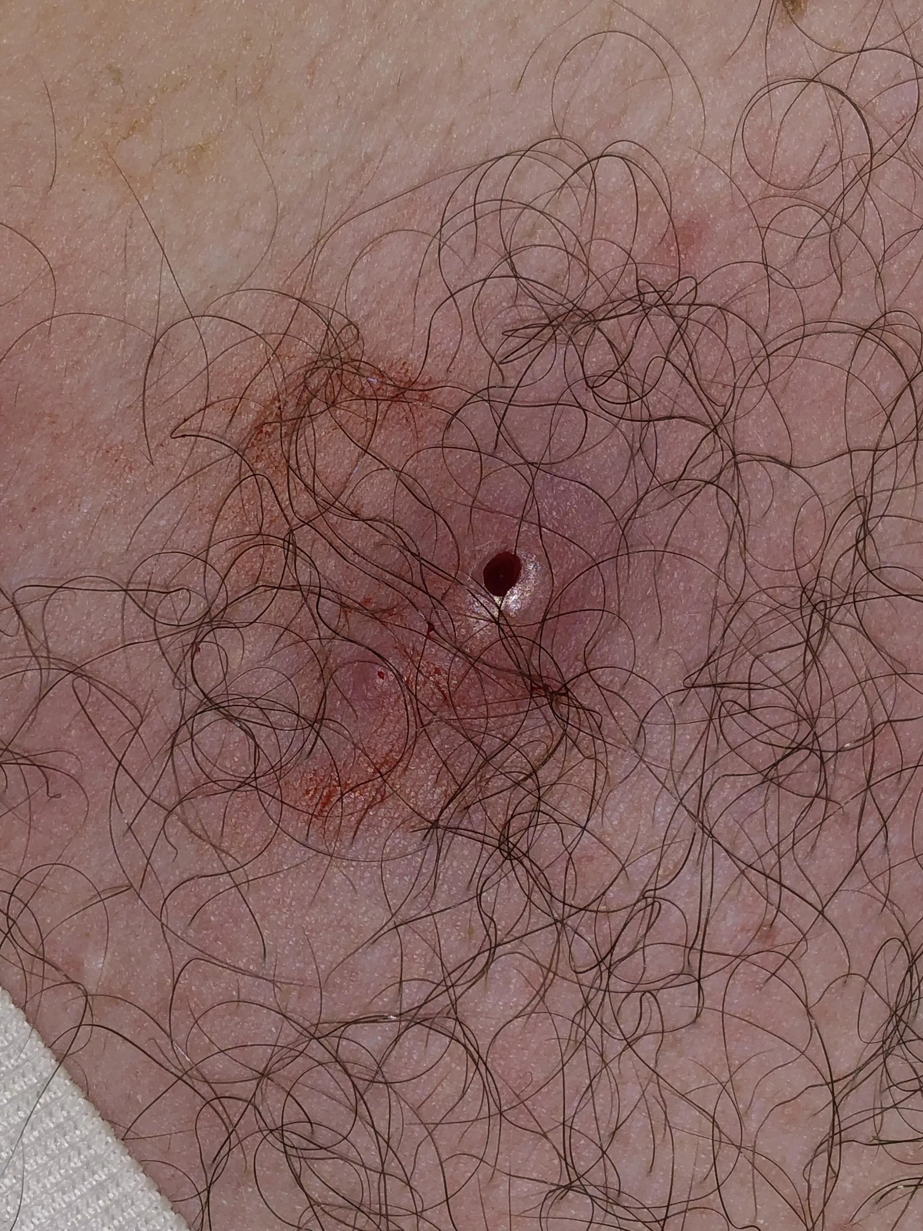 The remnants of a jumping spider bite I got on my chest. Was very leaky