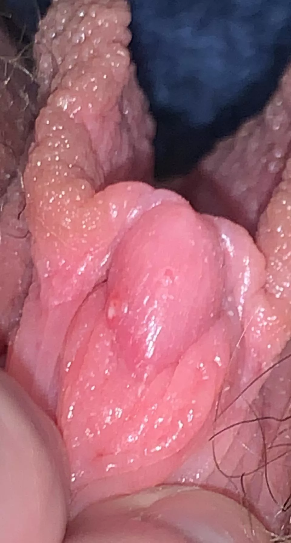 the return of dick zit: i popped it, but it’s not done with me yet. it wasn’t even satisfying. will keep you all updated