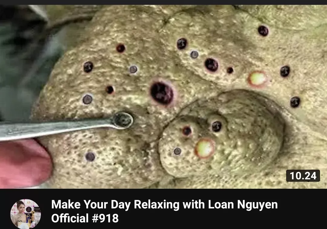 These thumbnails are getting worse by the day! Now they are apparently doing extractions on bloated corpses.