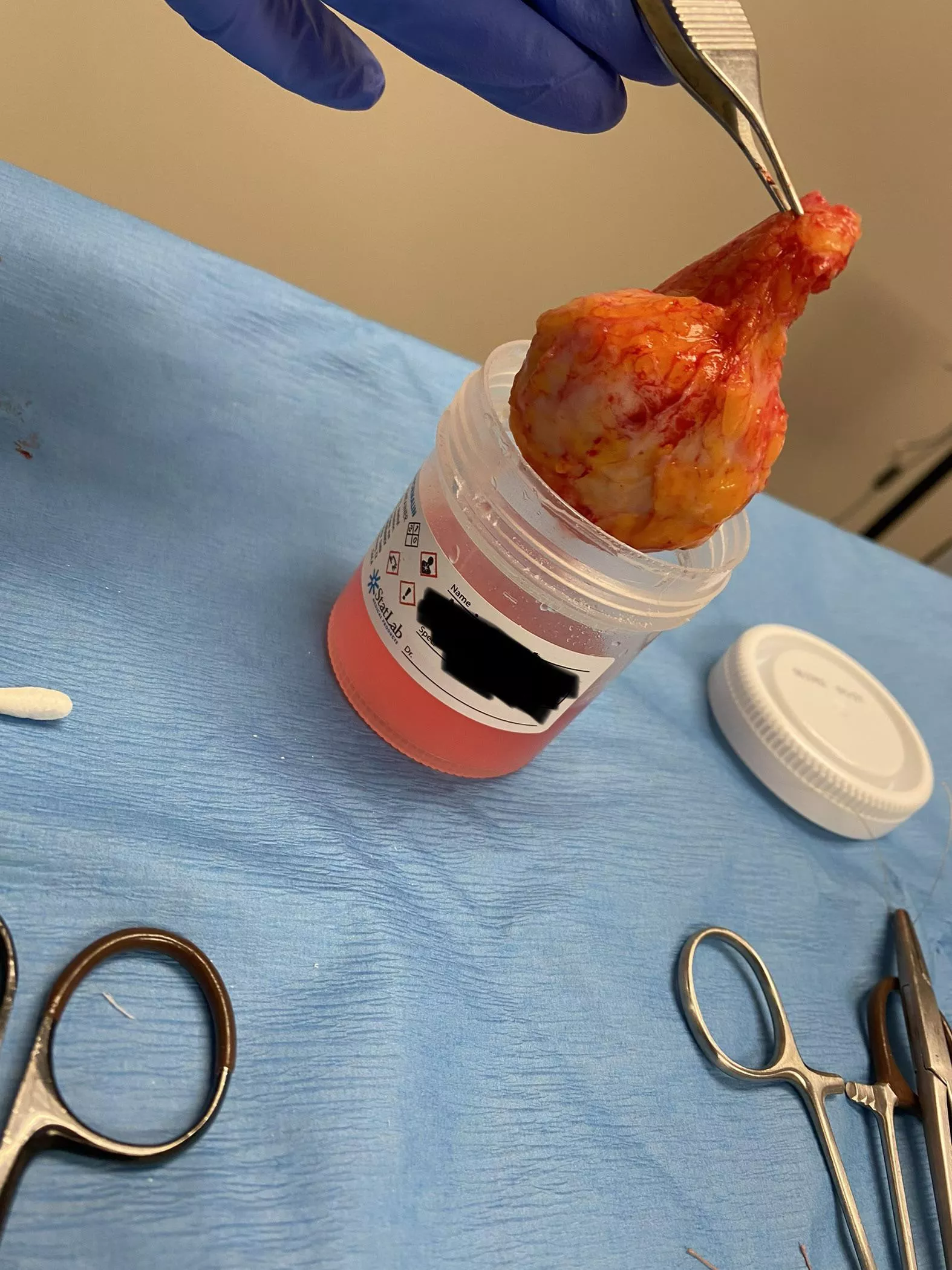 They removed this cyst from my girlfriend’s back today.